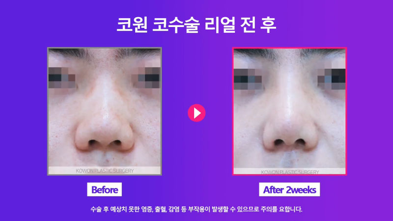 코끝연장과 보형물로 남자복코 개선한 후기! 사진 6