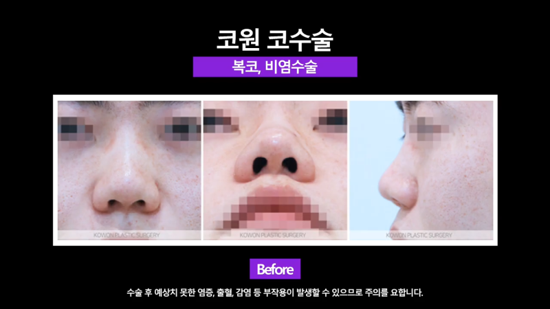 코끝연장과 보형물로 남자복코 개선한 후기! 사진 3