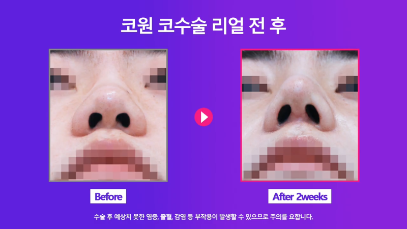 코끝연장과 보형물로 남자복코 개선한 후기! 사진 5