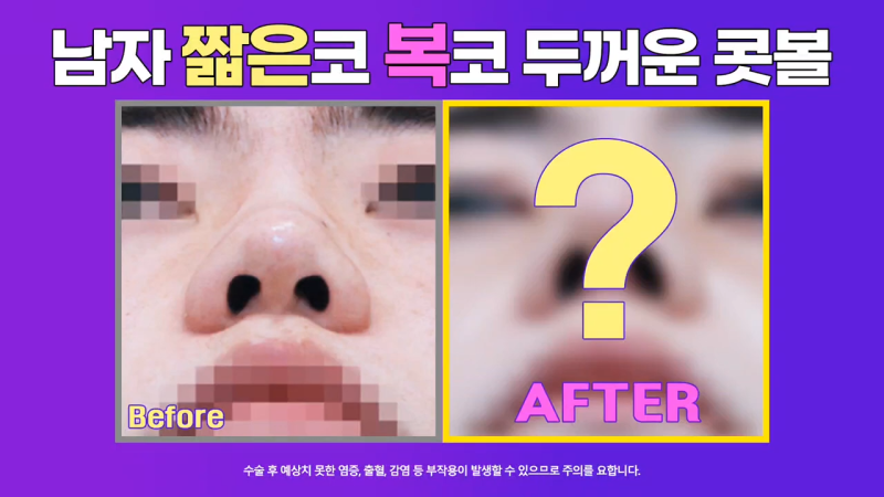 코끝연장과 보형물로 남자복코 개선한 후기!