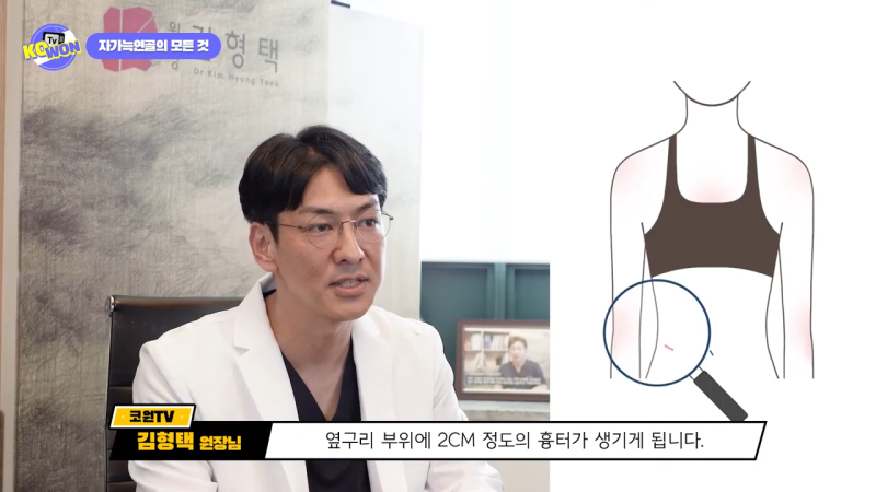 코 수술, 자가늑연골의 장점과 단점, 사용하기 적합한 경우는? - 1탄 사진 15