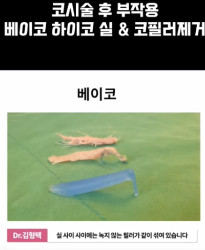 베이코/하이코 시술 부작용으로 실 제거와 필러 제거에 대하여-2편 사진 15