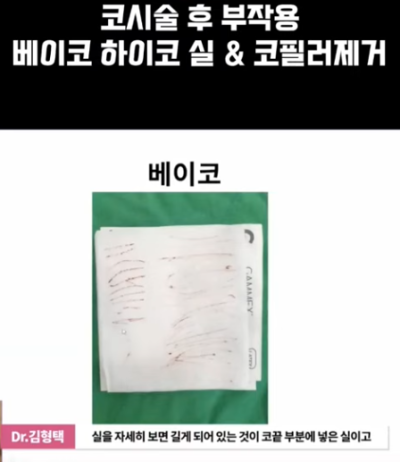 베이코/하이코 시술 부작용으로 실 제거와 필러 제거에 대하여-2편 사진 4
