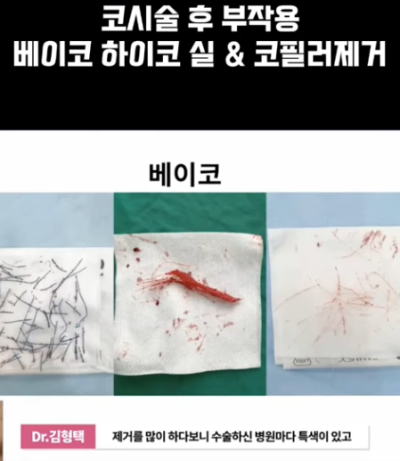 베이코/하이코 시술 부작용으로 실 제거와 필러 제거에 대하여-2편 사진 9