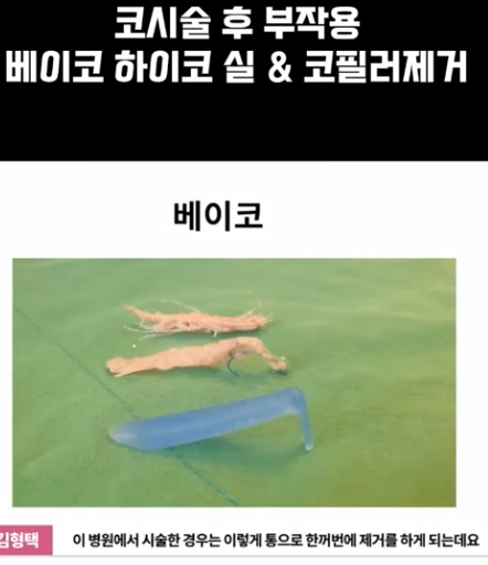 베이코/하이코 시술 부작용으로 실 제거와 필러 제거에 대하여-2편 사진 11