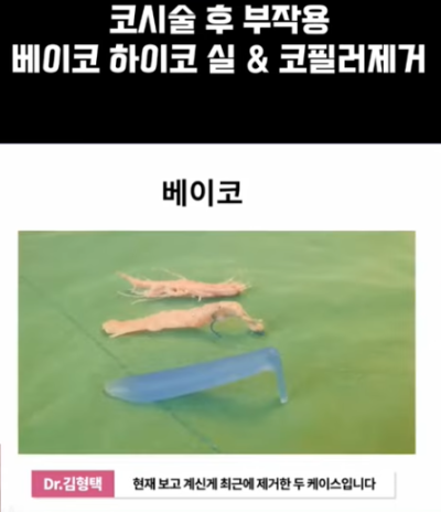 베이코/하이코 시술 부작용으로 실 제거와 필러 제거에 대하여-2편 사진 12