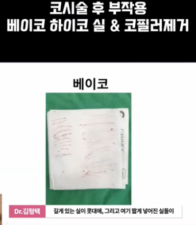 베이코/하이코 시술 부작용으로 실 제거와 필러 제거에 대하여-2편 사진 5