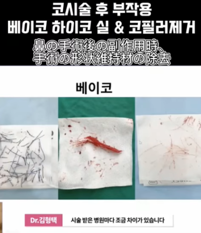 베이코/하이코 시술 부작용으로 실 제거와 필러 제거에 대하여-2편 사진 3