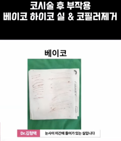 베이코/하이코 시술 부작용으로 실 제거와 필러 제거에 대하여-2편 사진 6