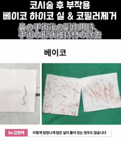 베이코/하이코 시술 부작용으로 실 제거와 필러 제거에 대하여-2편