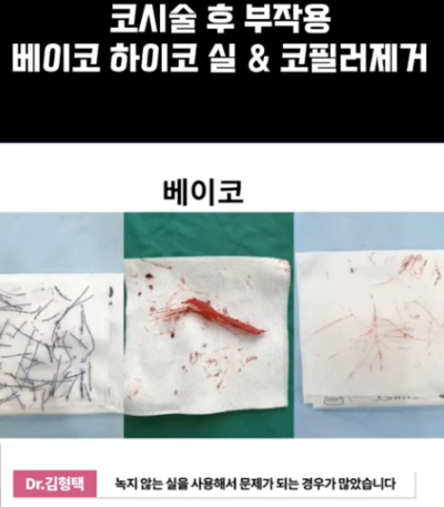 베이코/하이코 시술 부작용으로 실 제거와 필러 제거에 대하여-2편 사진 8