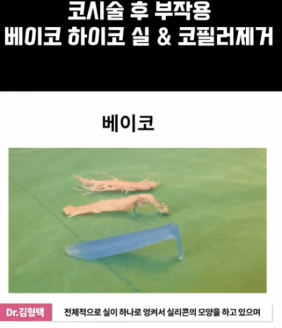 베이코/하이코 시술 부작용으로 실 제거와 필러 제거에 대하여-2편 사진 14