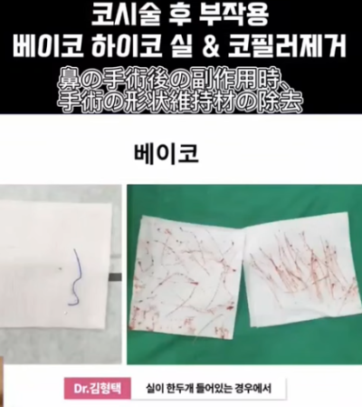 베이코/하이코 시술 부작용으로 실 제거와 필러 제거에 대하여-2편