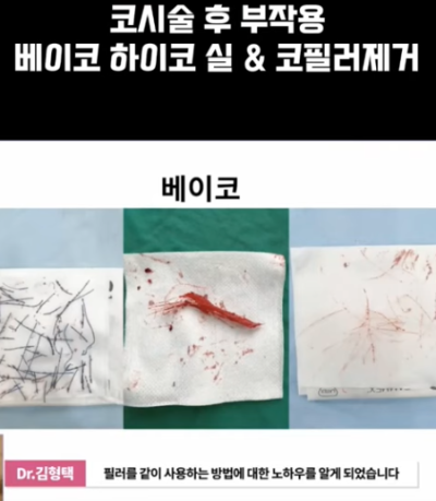 베이코/하이코 시술 부작용으로 실 제거와 필러 제거에 대하여-2편 사진 10
