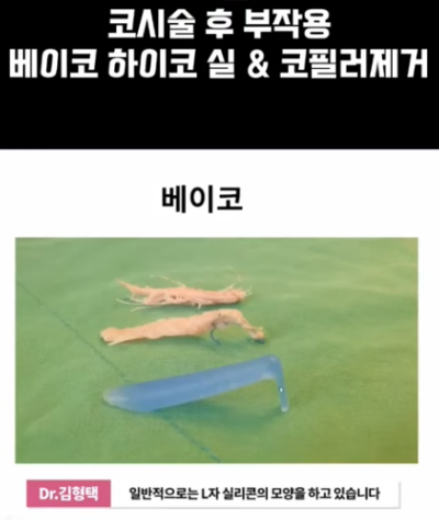 베이코/하이코 시술 부작용으로 실 제거와 필러 제거에 대하여-2편 사진 13