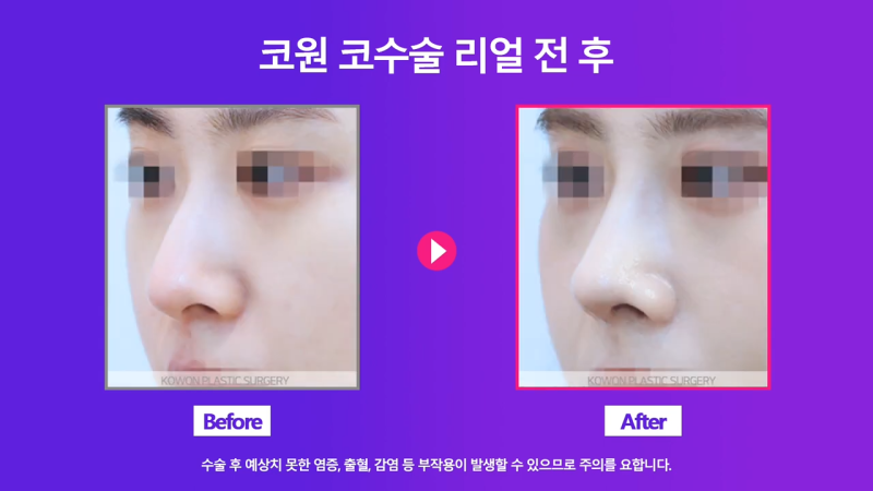 여자 복코, 코끝연골묶기로 개선! 사진 8