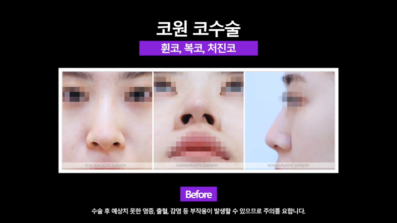 여자 복코, 코끝연골묶기로 개선!
