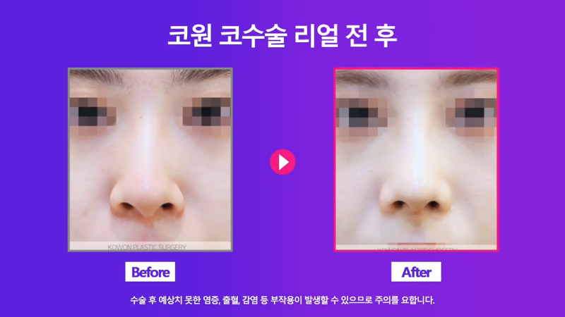 여자 복코, 코끝연골묶기로 개선! 사진 6