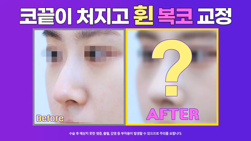 여자 복코, 코끝연골묶기로 개선!