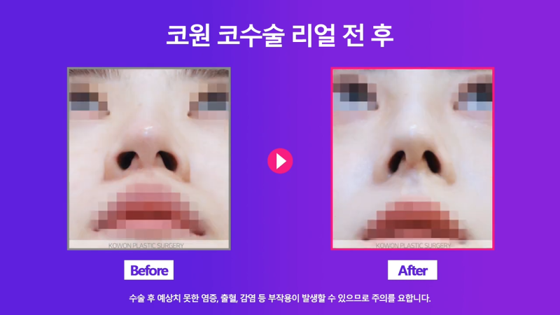 여자 복코, 코끝연골묶기로 개선! 사진 5