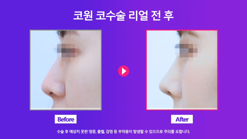 여자 복코, 코끝연골묶기로 개선! 사진 7