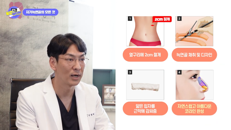 코 수술, 자가늑연골의 장점과 단점, 사용하기 적합한 경우는? - 2탄 사진 9