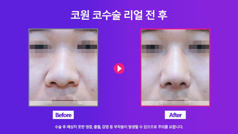 코끝 연골 묶기 + 실리콘으로 남자복코 개선했습니다! 사진 5