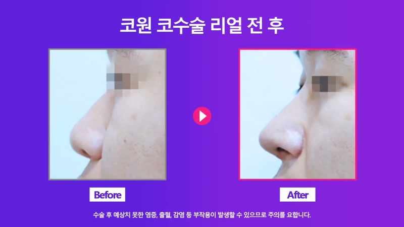 코끝 연골 묶기 + 실리콘으로 남자복코 개선했습니다! 사진 8