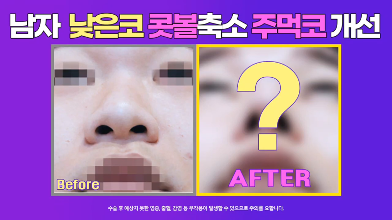 코끝 연골 묶기 + 실리콘으로 남자복코 개선했습니다!