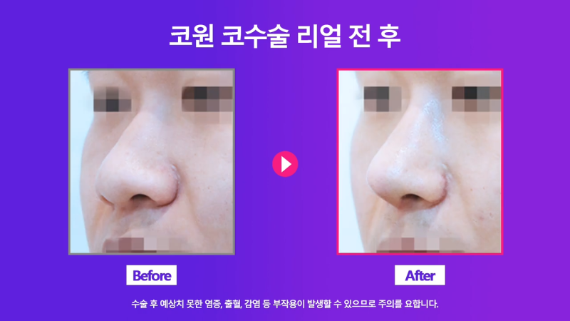 코끝 연골 묶기 + 실리콘으로 남자복코 개선했습니다! 사진 7