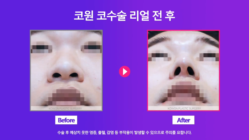 코끝 연골 묶기 + 실리콘으로 남자복코 개선했습니다! 사진 6