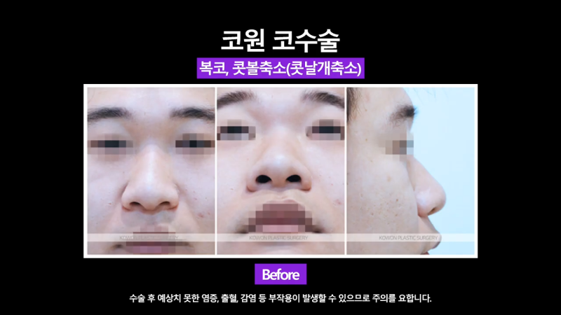 코끝 연골 묶기 + 실리콘으로 남자복코 개선했습니다!