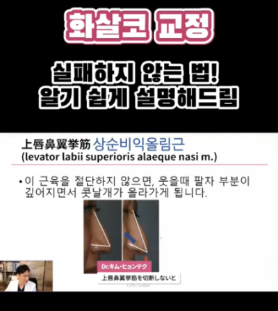 화살코 교정, 어떻게 하는 걸까요? 화살코 + 매부리코였던 여성분 3개월 후 전후 모습 비교 사진 4