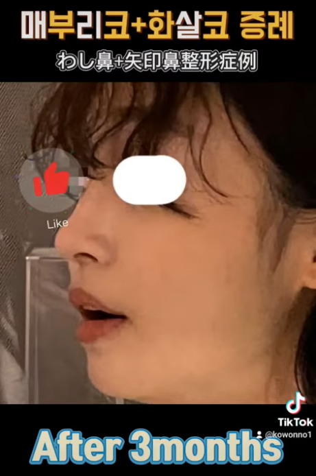 화살코 교정, 어떻게 하는 걸까요? 화살코 + 매부리코였던 여성분 3개월 후 전후 모습 비교 사진 11