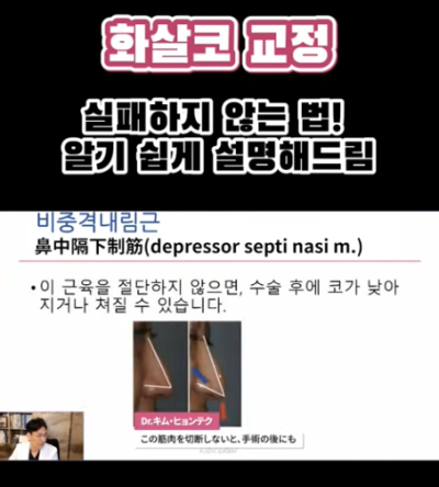 화살코 교정, 어떻게 하는 걸까요? 화살코 + 매부리코였던 여성분 3개월 후 전후 모습 비교 사진 3