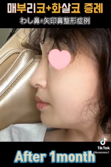 화살코 교정, 어떻게 하는 걸까요? 화살코 + 매부리코였던 여성분 3개월 후 전후 모습 비교 사진 9