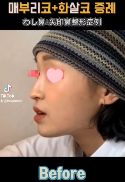 화살코 교정, 어떻게 하는 걸까요? 화살코 + 매부리코였던 여성분 3개월 후 전후 모습 비교 사진 7