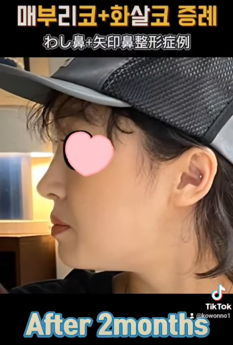 화살코 교정, 어떻게 하는 걸까요? 화살코 + 매부리코였던 여성분 3개월 후 전후 모습 비교 사진 10