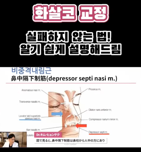 화살코 교정, 어떻게 하는 걸까요? 화살코 + 매부리코였던 여성분 3개월 후 전후 모습 비교 사진 5