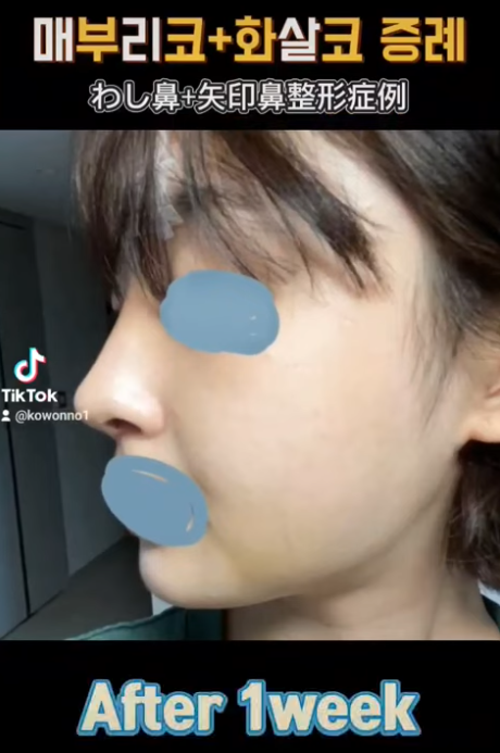 화살코 교정, 어떻게 하는 걸까요? 화살코 + 매부리코였던 여성분 3개월 후 전후 모습 비교 사진 8