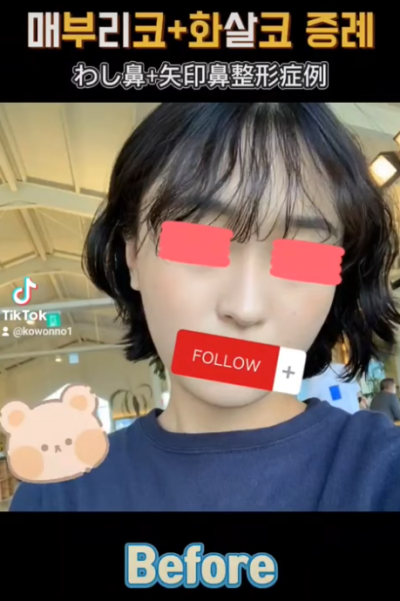 화살코 교정, 어떻게 하는 걸까요? 화살코 + 매부리코였던 여성분 3개월 후 전후 모습 비교 사진 6