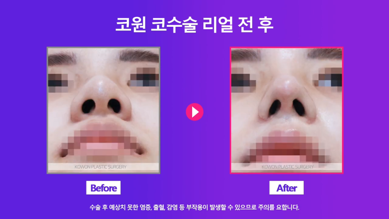 콧볼축소, 콧날개자르기 수술로 여자 복코 개선 성공! 수술 2주 경과 전후 모습 비교! 사진 8