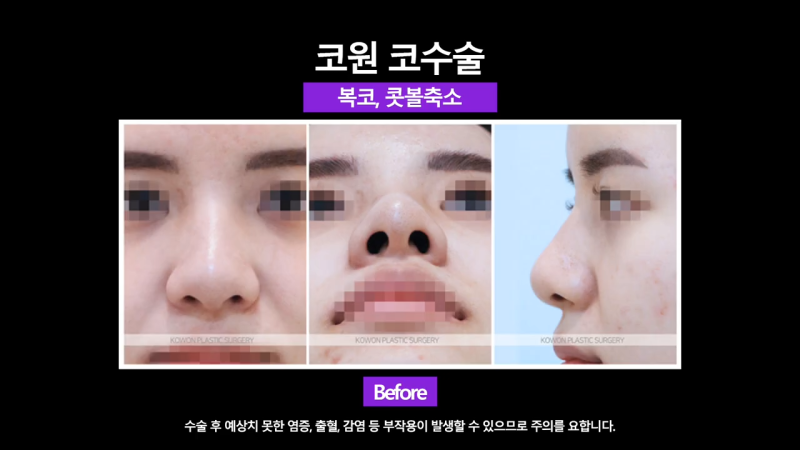 콧볼축소, 콧날개자르기 수술로 여자 복코 개선 성공! 수술 2주 경과 전후 모습 비교! 사진 3