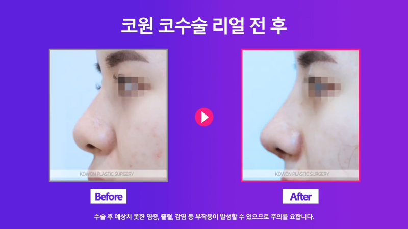 콧볼축소, 콧날개자르기 수술로 여자 복코 개선 성공! 수술 2주 경과 전후 모습 비교! 사진 7