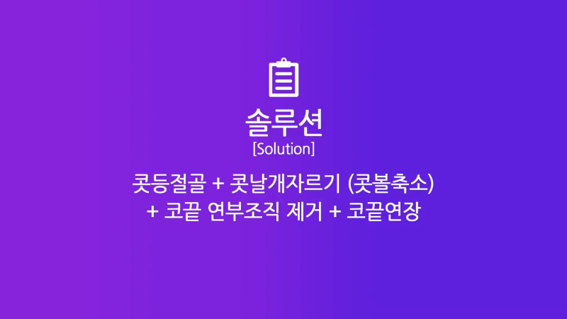 콧볼축소, 콧날개자르기 수술로 여자 복코 개선 성공! 수술 2주 경과 전후 모습 비교! 사진 4