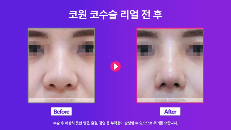 콧볼축소, 콧날개자르기 수술로 여자 복코 개선 성공! 수술 2주 경과 전후 모습 비교! 사진 5