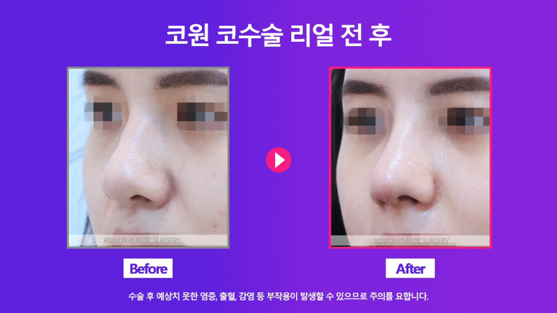콧볼축소, 콧날개자르기 수술로 여자 복코 개선 성공! 수술 2주 경과 전후 모습 비교! 사진 6