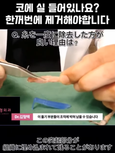 하이코, 베이코, 미스코 시술 후 코실제거, 한 번에 해야 합니다! 수술 사례보고 전후 비교해 봅시다. 사진 5
