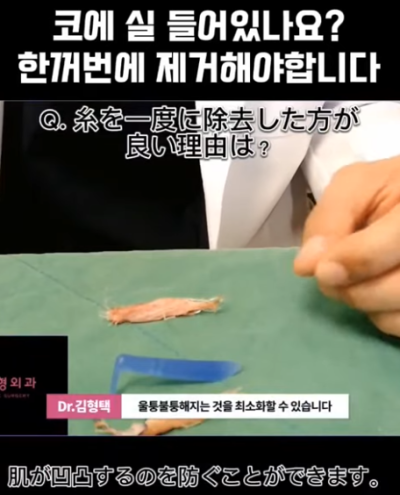 하이코, 베이코, 미스코 시술 후 코실제거, 한 번에 해야 합니다! 수술 사례보고 전후 비교해 봅시다. 사진 11