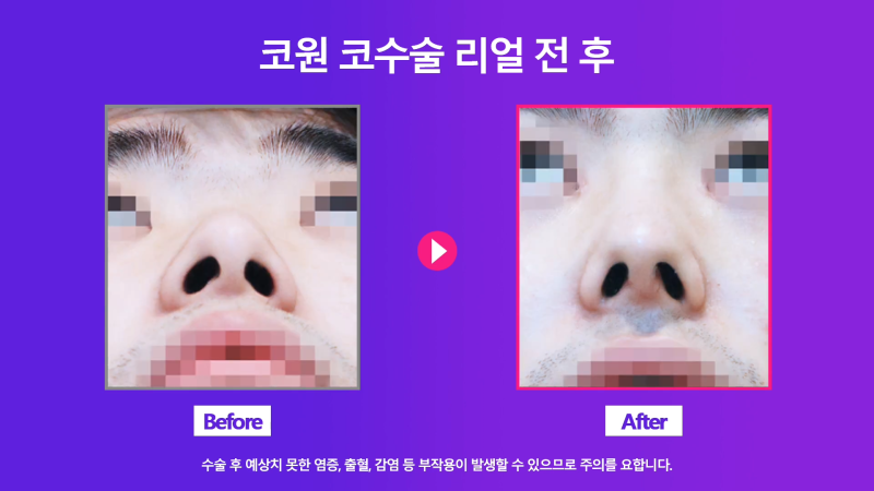 남자휜코 비중격만곡증과 비염의 관계성과 개선을 위한 수술 방법 사진 6
